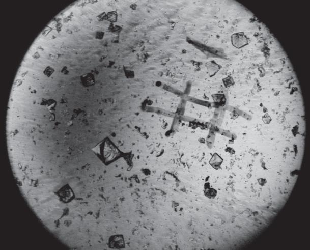 Картина кристаллизации мочи крыс при заражении T. spiralis в дозе 100 личинок (× 60)